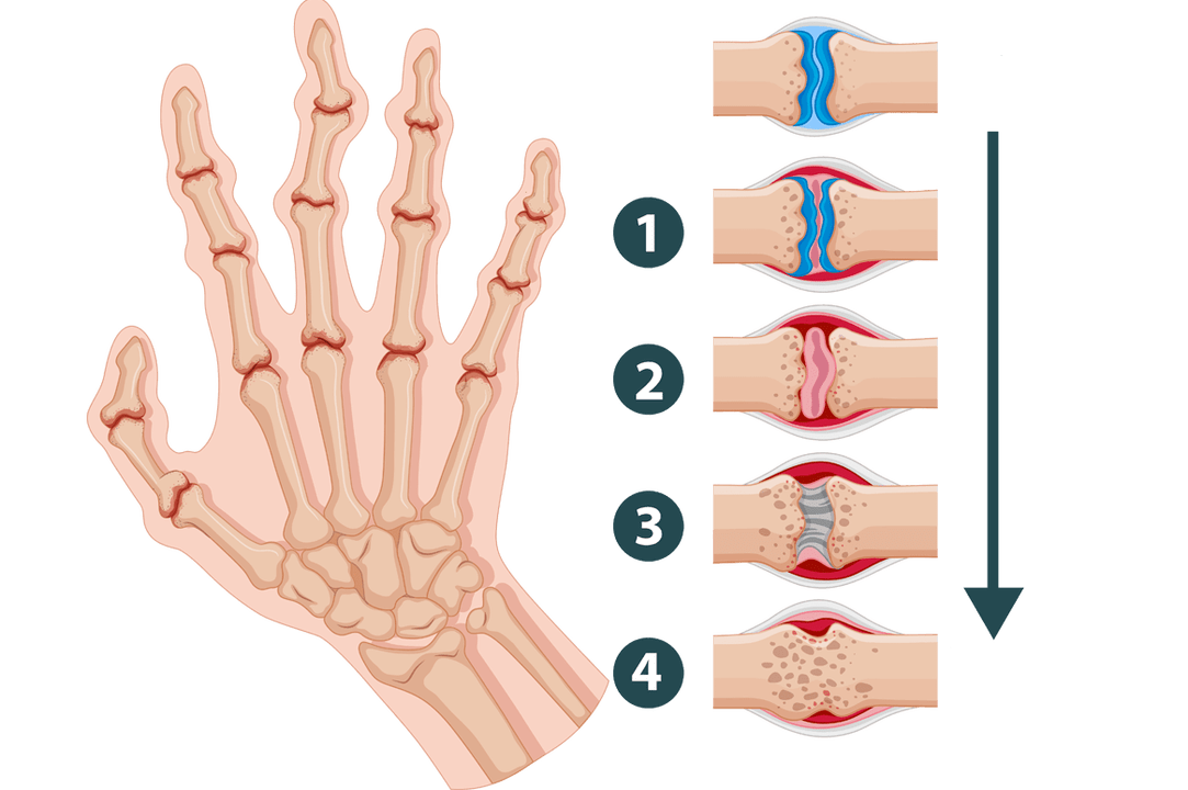 Etapy rozvoje artritidy - zánětlivé poškození kloubů