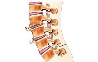spondylartróza jako příčiny bolesti zad