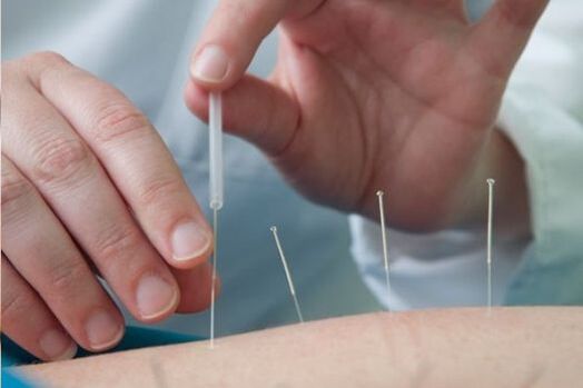 Akupunktura je metoda léčby bolesti v bederní oblasti způsobené osteochondrózou