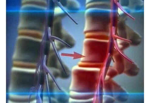 Komprese nervových zakončení u bederní osteochondrózy