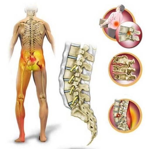 Osteochondróza bederní páteře, která způsobuje bolesti dolní části zad