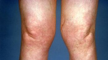 deformace kolenních kloubů s artrózou