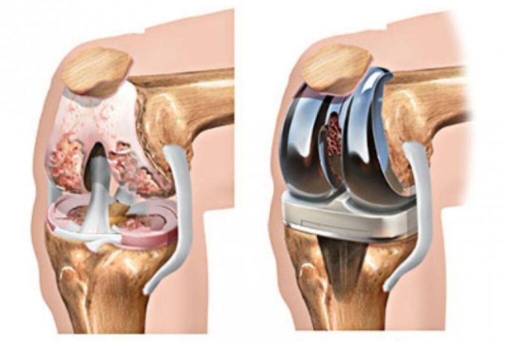endoprotéza kolenního kloubu pro artrózu