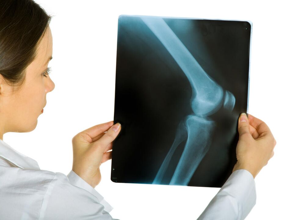 Rentgenový snímek kolenního kloubu odhalí přítomnost deformující artrózy