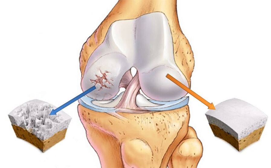 Zdravý kolenní kloub (vpravo) a postižený artrózou (vlevo)